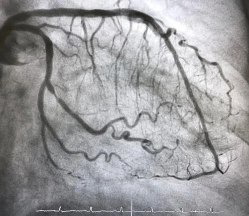 A coronary angiogram showing the branching blood vessels of the heart.