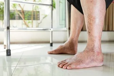 Swollen, discolored legs and feet with a walker in the background.