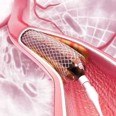 A medical illustration showing a wire mesh stent being deployed inside an artery.