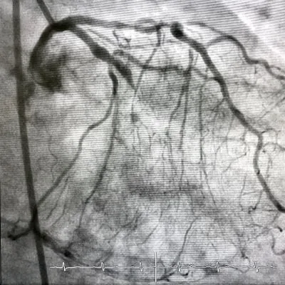 A grainy, black-and-white medical angiogram showing a detailed network of coronary arteries.