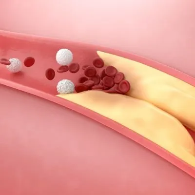 3D illustration of an artery narrowed by yellow plaque buildup, obstructing the flow of blood cells.